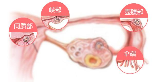 输卵管堵塞怎么治疗？郑州天伦不孕不育快速疏通 当月怀孕