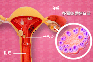 多囊卵巢能治好吗？求子4年在郑州天伦成功好孕！