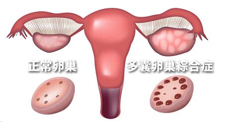 郑州天伦专家解析：多囊卵巢综合征