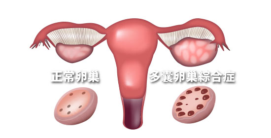 郑州天伦专家解析：肥胖与多囊卵巢的关系