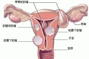 子宫内膜增厚怎么治疗?且听郑州天伦专家如何解析!