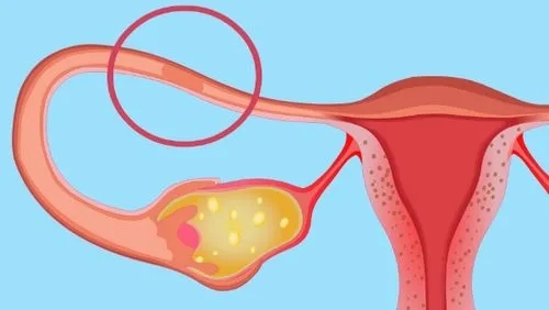 输卵管堵塞跟盆腔炎有关系吗?