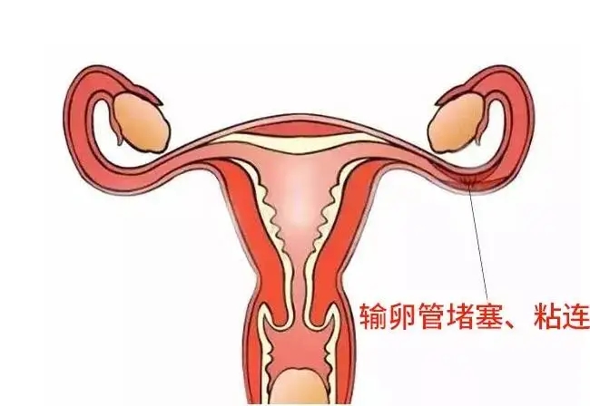 输卵管性不孕的原因有哪些？