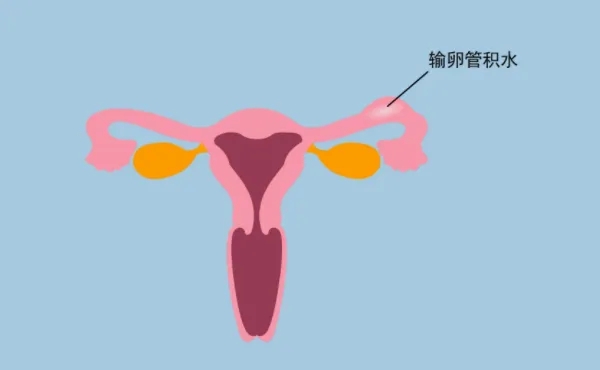输卵管堵塞需要怎么治疗效果好?