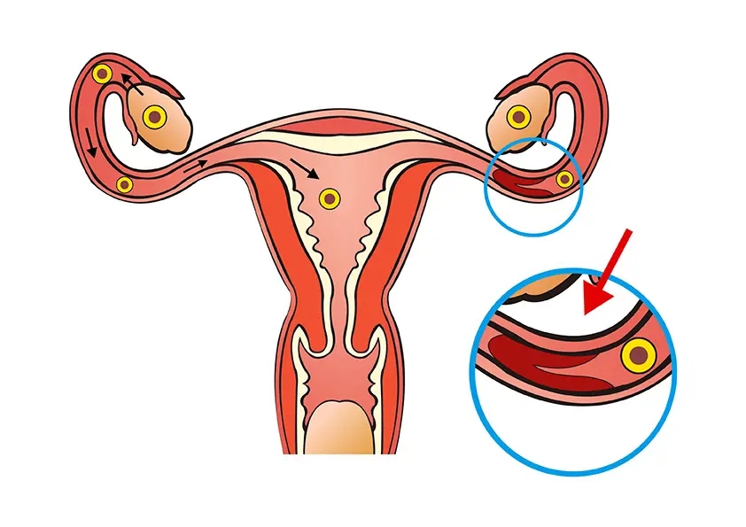 输卵管堵塞的危害你知道多少?