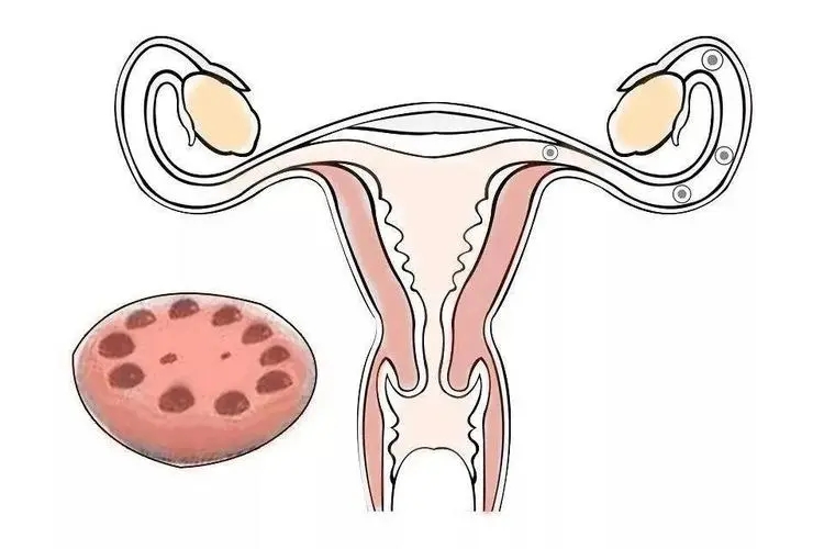 多囊卵巢怎么检查出来的?