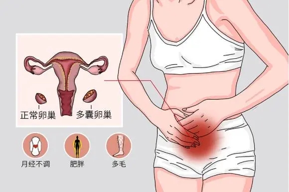 多囊卵巢患者如何提高受孕几率呢?